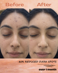 Targeted Dark Spot Care, 1% Kojic Acid